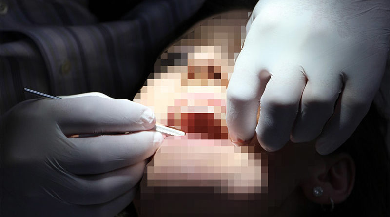 Acude al dentista y le encuentran restos de preservativo entre los dientes